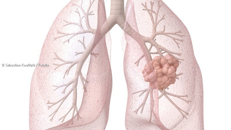 Lungenkrebs Ursachen Symptome Und Behandlung