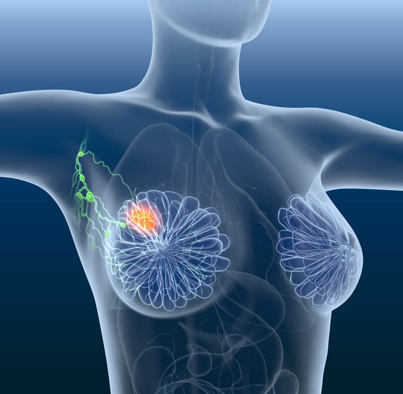 36++ Lungenkrebs wo bilden sich metastasen , ᐅ Die Lymphknotenausräumung (Lymphadenektomie) zur Entfernung von Tumoren