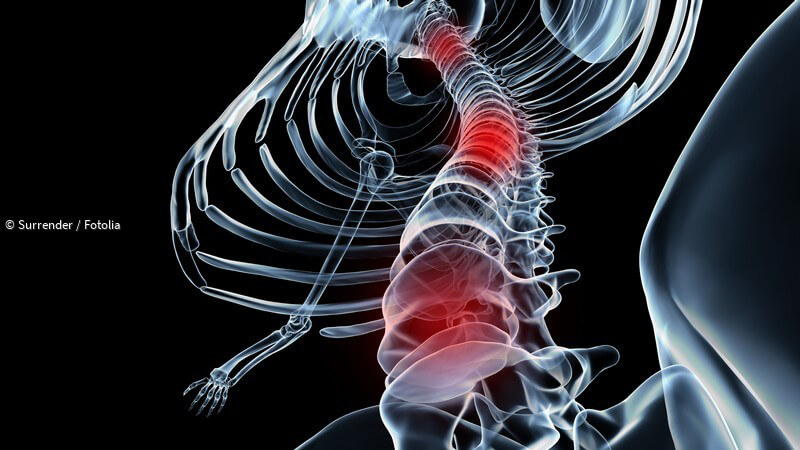 ᐅ Spondylarthrose - Arthrose in der Wirbelsäule