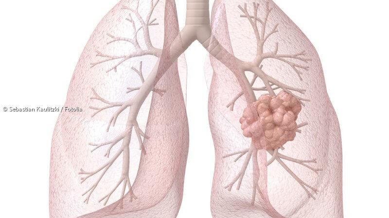 38++ Lungenkrebs wo bilden sich metastasen , ᐅ LungenkrebsStadien Wissenswertes zur TNMKlassifikation