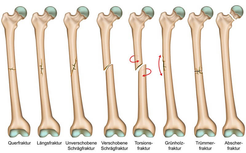 ᐅ Knochenbruche Ursachen Symptome Behandlung Und Vorbeugemoglichkeiten